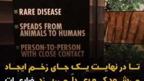 نشانه‌ های آبله میمونی  چگونه به آن مبتلا می‌شوید ؟