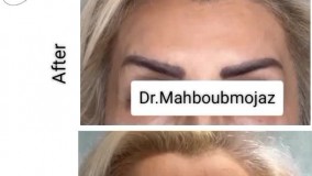 نمونه بوتاکس