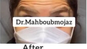 رفع خطوط پیشانی