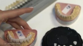 لمینت دندان