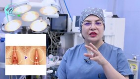 لابیاپلاستی