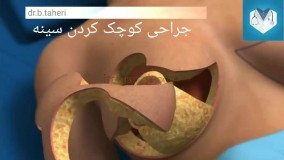 جراحی کوچک کردن سینه