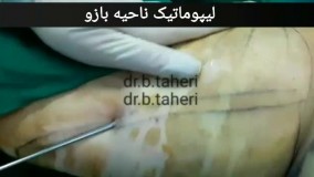 لیپوماتیک بازو