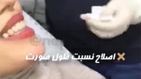 زاویه دار کردن چانه