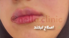 تغییر حجم لب ها