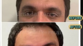 لیفت ابرو اندوسکوپیک