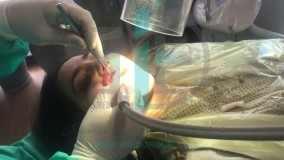 مکنده آلاینده های دندانپزشکی Fume Eliminator
