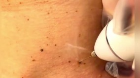 برداشت اسکین تگ