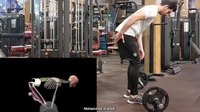 آسیب شدید ددلیفت رومانیایی romanian deadlift