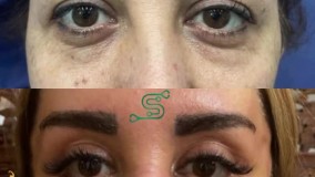 دکتر سیامک صدیقی- بلفاروپلاستی و لیفت شقیقه