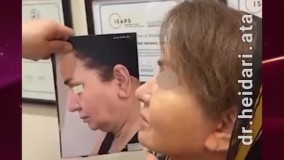 لیفت کامل صورت، گردن، پیشانی و تزریق چربی
