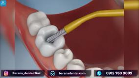 نحوه پر کردن دندان با مواد کامپوزیت چگونه است؟