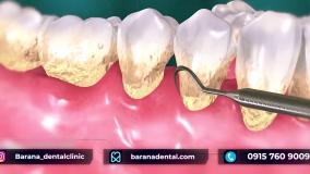 ضرورت انجام جرم گیری برای جلوگیری از تحلیل لثه