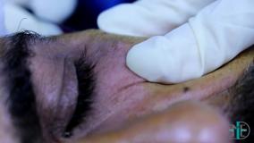 رفع سیاهی دور چشم با دستگاه پزشکی Endo-RF Subcision