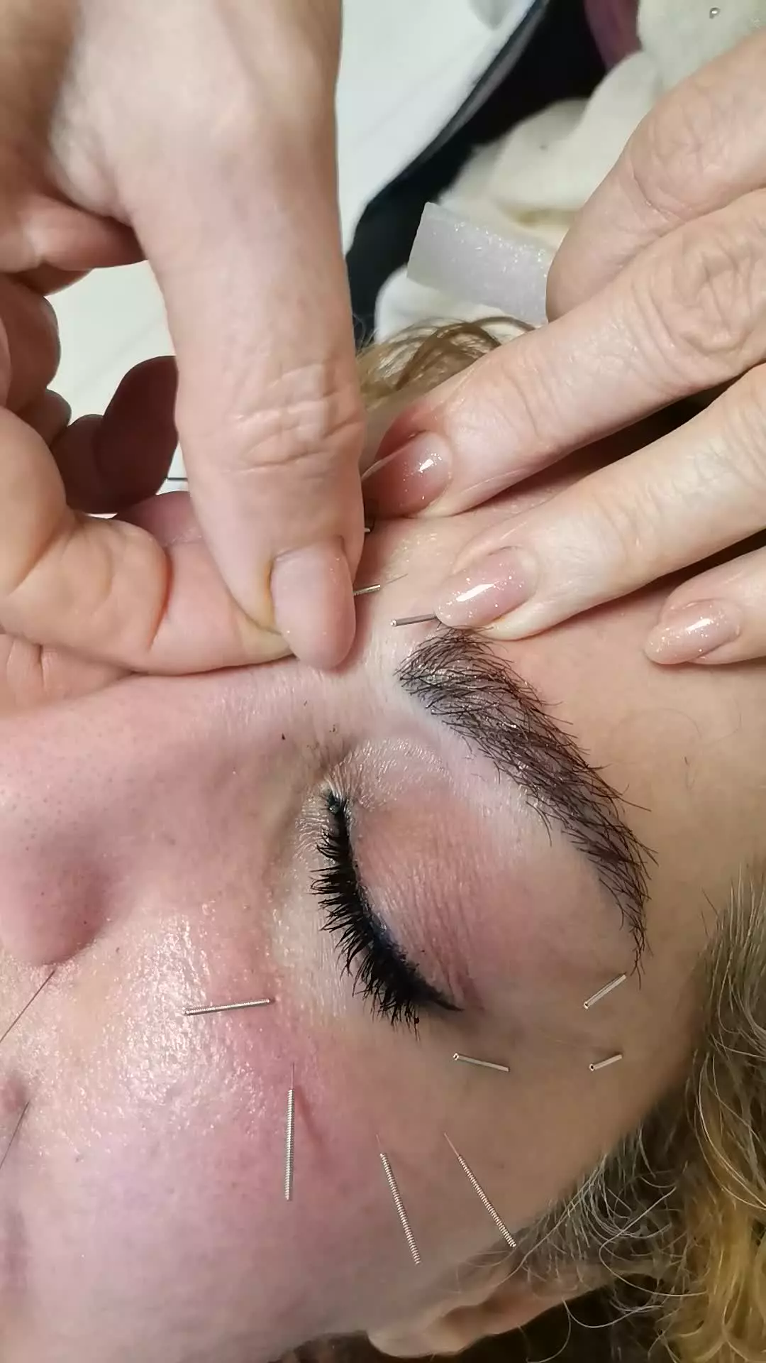 از بین بردن خطوط اخم روی پیشانی