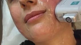 هایفو ماشین کلاژن ساز