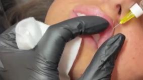 تزریق زیبای فیلر لب روسی