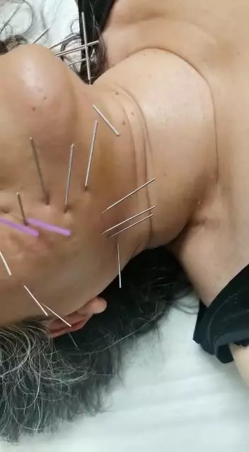 از بین بردن غبغب با طب سوزنی