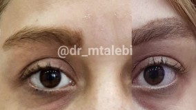 مزوتراپی تیرگی دور چشم