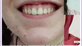 تزریق بوتاکس جهت رفع لبخند لثه‌ای