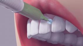چگونه باید از مسواک ایمپلنت استفاده کرد؟