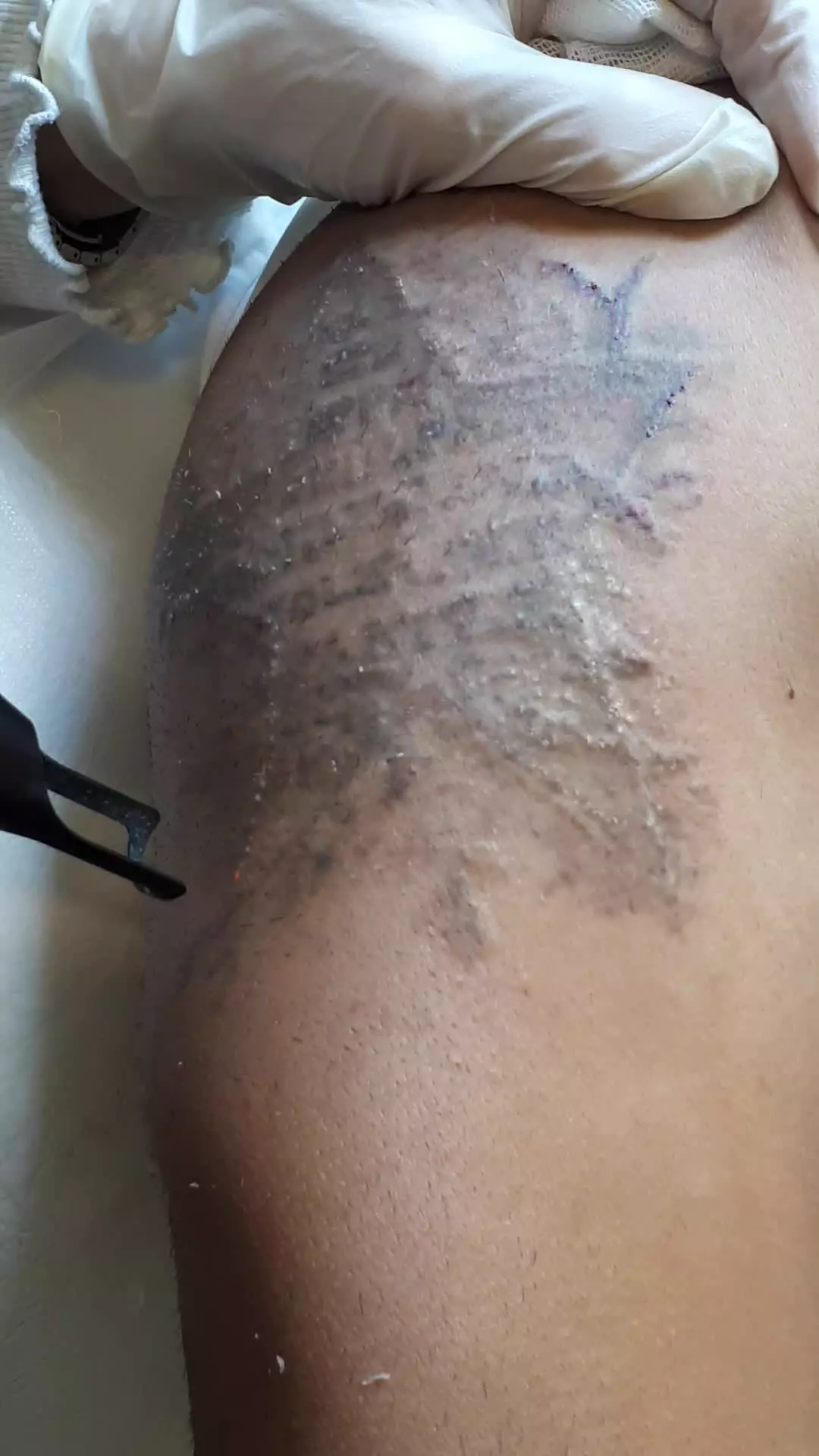 ریموو و پاک کردن تتو