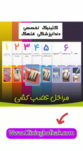 مراحل عصب کشی دندان