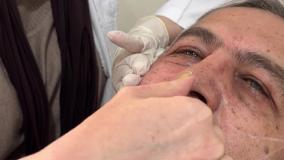 لیفت صورت با نخ جوانساز