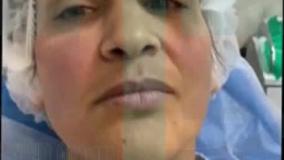 لیفتینگ و جوانسازی پوست با دستگاه پزشکی  Endo-RF Subcision