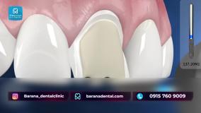 قیمت لمینت دندان در مشهد در کلینیک بارانا