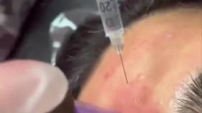 مزونیدلینگ صورت مشتری