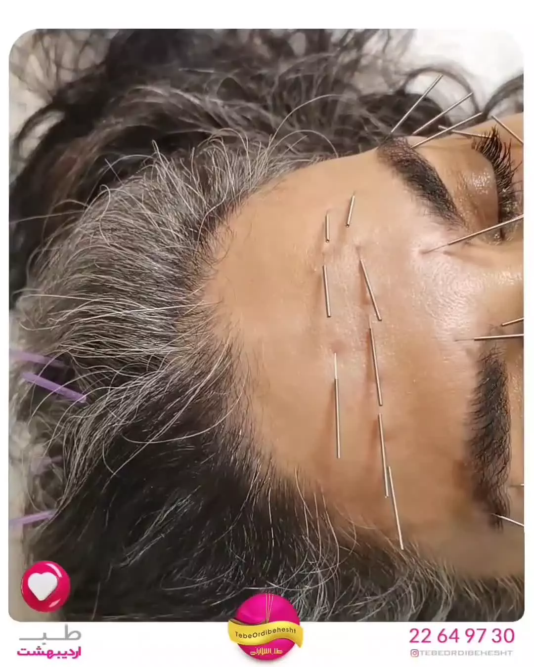 جوانسازی صورت با طب سوزنی