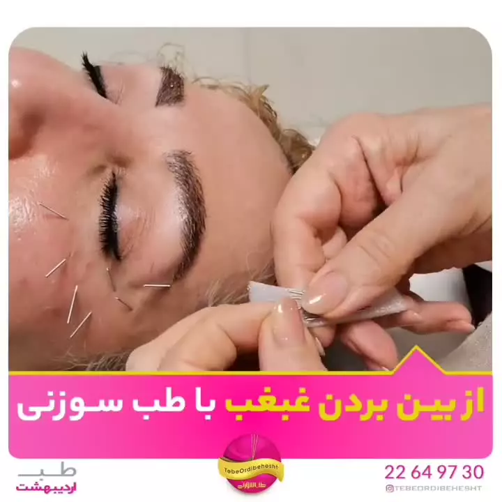 رفع غبغب و خط اخم وخنده با طب سوزنی