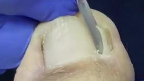 چه زمانی جراحی ناخن پا لازم است