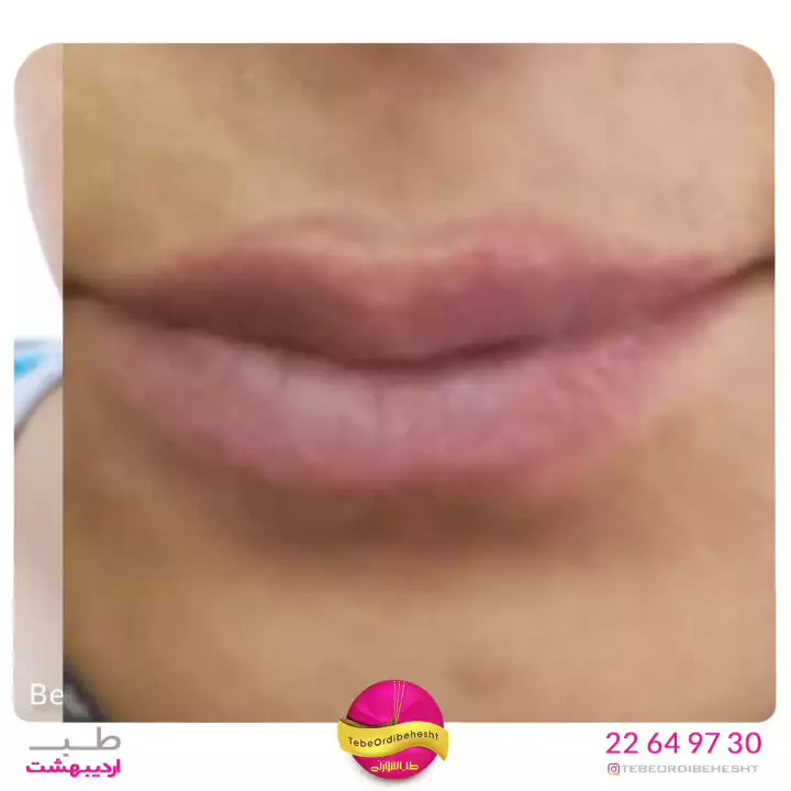 حذف تاتو لب با لیزر📍