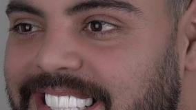 انجام لمینت بعد از ایمپلنت دندان