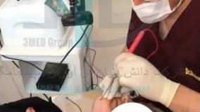 از بین بردن غبغب با دستگاه پزشکی Endo-RF Subcision