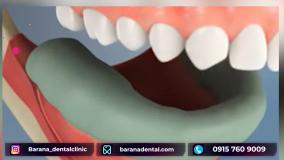 اینلای؛ یکی از شیوه های ترمیم دندان