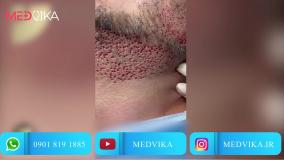 کاشت ریش در مشهد و تاثیر آن بر جذابیت چهره