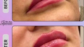 نمونه کار فیلر لب