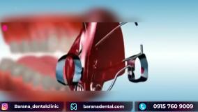 چگونه ارتودنسی نامرئی در دهان جای می گیرد؟