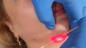 اندوليفت غبغب دکتر مولایی فر