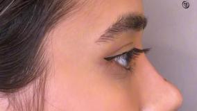 نمونه کار فیلر بینی