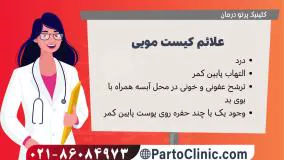 علائم کیست مویی کمر چیست-partoclinic