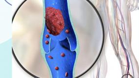 راهکارهای پیشگیری از آمبولی ناشی از عمل های زیبایی