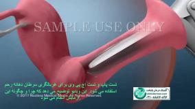 فیلم نحوه آزمایش hpv در زنان - کلینیک پایتخت