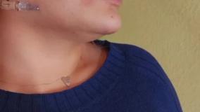 جوانسازی و زاویه سازی صورت با مزوژل :