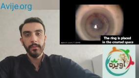 انواع معافیت پزشکی قوز قرنیه