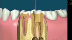 درمان ریشه دندان