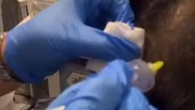 از بین بردن ریزش مو با دستگاه پزشکی Carboxy Therapy